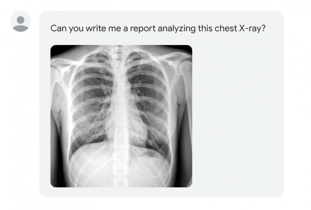can you write me a report using this chest X-ray ?